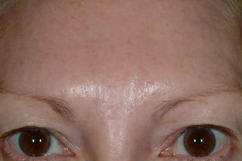 Brow asymmetry after 89239