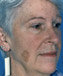 Facelift 507828
