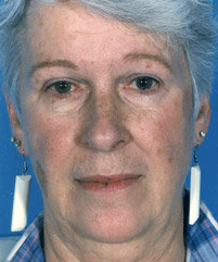 Facelift before 507828
