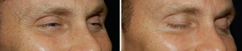 Botox for Crows Feet before 97868