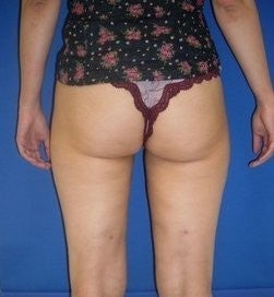 Laser Liposuction 561211