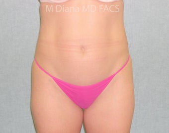 SmartLipo before 607526