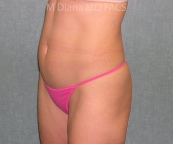 SmartLipo 607526