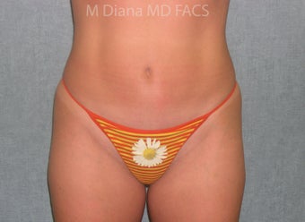 SmartLipo after 607526