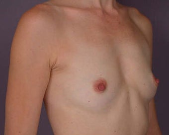 Breast Augmentation before 281427