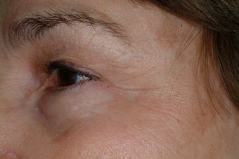 Crow's feet treatment before 89242
