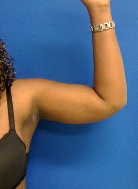 Laser Liposuction after 561207