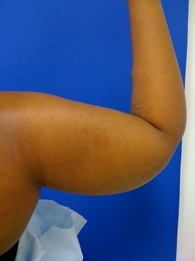 Laser Liposuction 561207