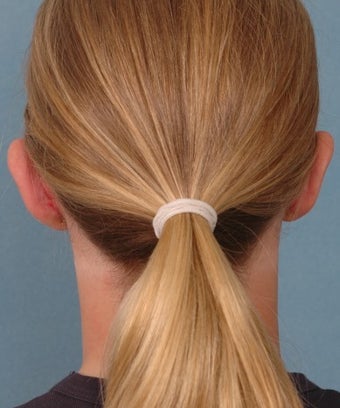 Otoplasty 1268328
