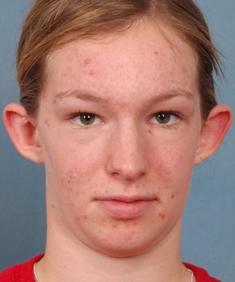 Otoplasty before 1268328