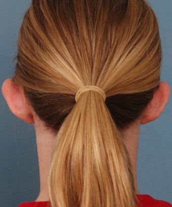 Otoplasty 1268328