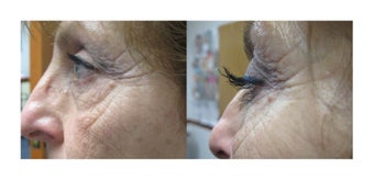 Before and 3 months after Regular Latisse use before 240083