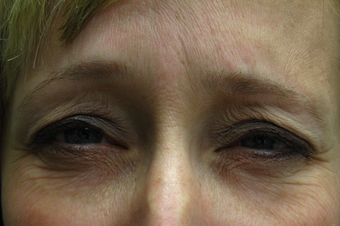 Botox before and after maximum frowning after 1307480