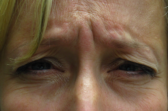 Botox before and after maximum frowning before 1307480