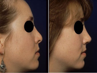 Rhinoplasty Revision before 84174