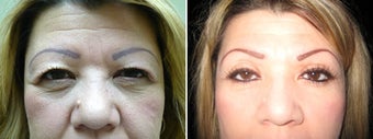 Cosmetic eyelid surgery before 128412