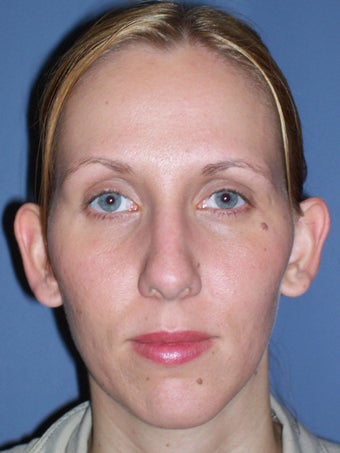 Otoplasty, Ear Surgery before 731960