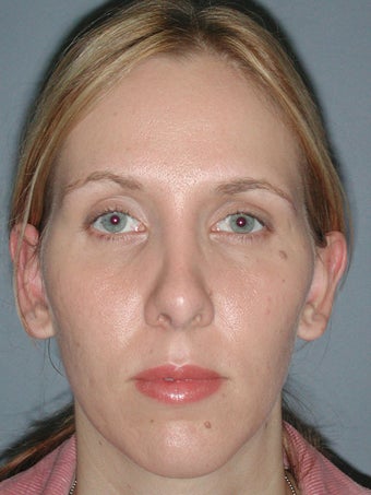 Otoplasty, Ear Surgery after 731960