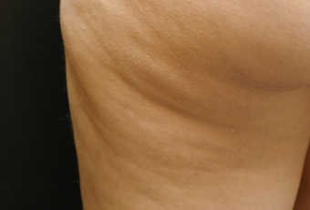 Cellulaze - Cellulite Treatment before 614786