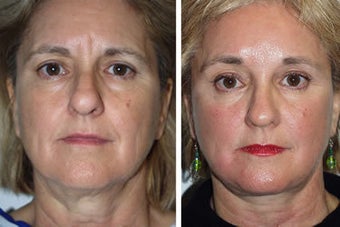 Facelift before 91350