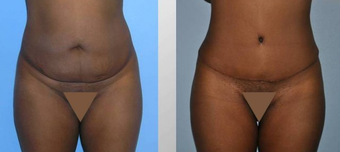 Tummy Tuck (Abdominoplasty) before 258057