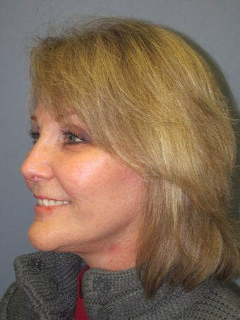 Chin Augmentation 731941