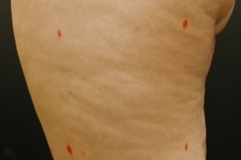 Cellulite Treatment - Cellulaze before 606625