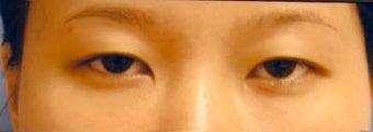 blepharoplasty before 1065148