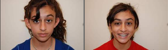 Otoplasty before 95865