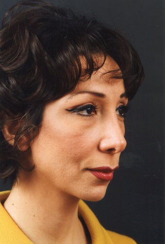 Chin implant elongates the jawline, bringing the face into balance. after 739627