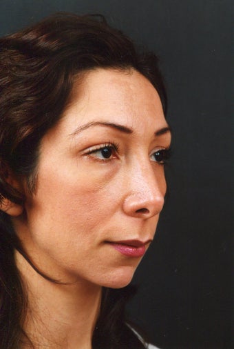 Chin implant elongates the jawline, bringing the face into balance. before 739627