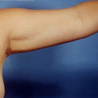 Arm Liposuction after 652127