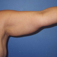 Arm Liposuction before 652127