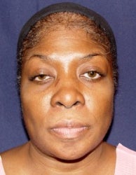 Rhinoplasty Front View before 874488