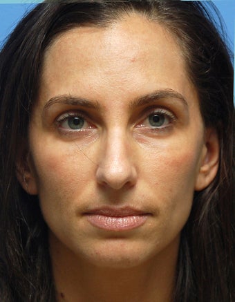 Eye Dermafillers,Cheek Dermafillers,Facial Dermafillers after 333311