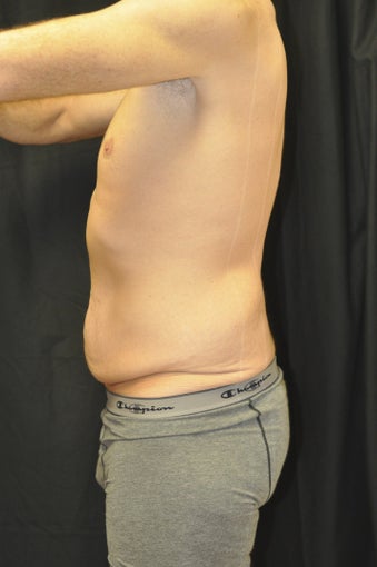 Body Lift 543259