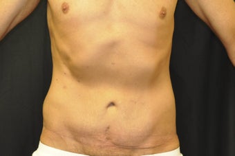 Body Lift after 543259