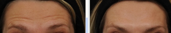 Before and After BOTOX® Cosmetic - frown lines, forehead lines, crow's feet 631340