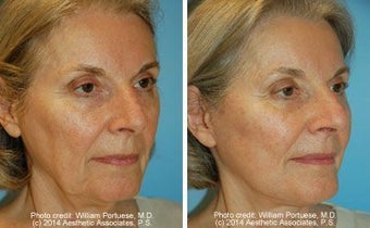 Facelift before 162250