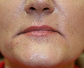 Juvederm into downturned corners of mouth before 845638
