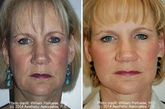 Face lift with dermabrasion before 91405