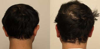 Otoplasty in a male patient before 1181704