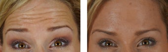 Botox to the Forehead/Glabella after 1312760