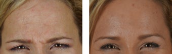 Botox to the Forehead/Glabella before 1312760