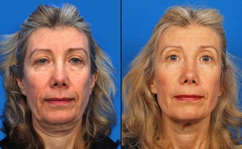 Ultherapy before 411580