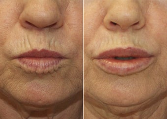 57 Year Old Female Treated for thin lips before 1229599