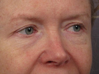 Eyelid Surgery before 280835