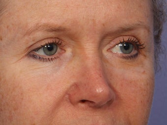 Eyelid Surgery after 280835