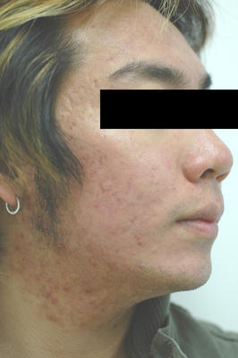 Photodynamic Therapy for Acne after 83005