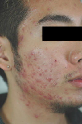 Photodynamic Therapy for Acne before 83005